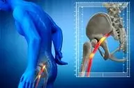 راه‌های طبیعی درمان سیاتیک؛ روش های غیردارویی که درد را کم می‌کنند