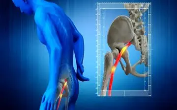 راه‌های طبیعی درمان سیاتیک؛ روش های غیردارویی که درد را کم می‌کنند