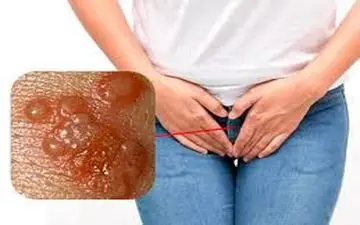 زگیل تناسلی، تهدیدی خاموش؛ از مدت زمان رابطه تا نحوه انتقال!
