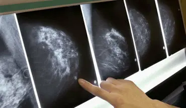 از هر هشت زن یک نفر به سرطان سینه مبتلا می‌شود