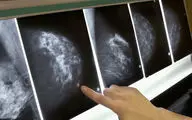از هر هشت زن یک نفر به سرطان سینه مبتلا می‌شود