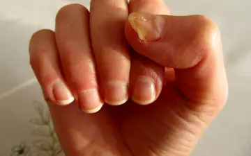 درمان‌های خوراکی و موضعی قارچ ناخن