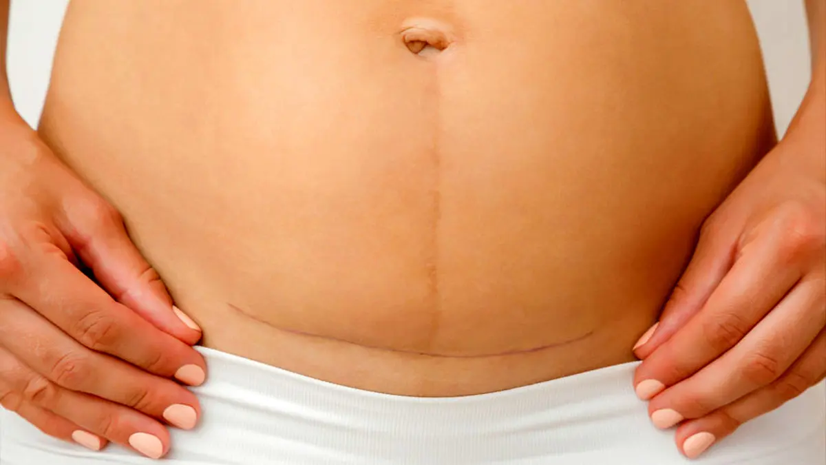 خداحافظی با شکم شل بعد از بارداری! ۹ روش موثر برای سفت شدن شکم
