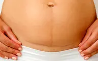 خداحافظی با شکم شل بعد از بارداری! ۹ روش موثر برای سفت شدن شکم
