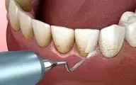 هشدار| جرم‌گیری دندان خطرناک است!