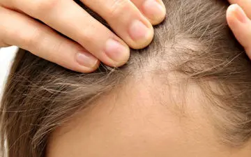 چگونه از ریزش موی ناگهانی در دوران شیردهی جلوگیری کنیم؟