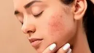 آکنه نشانه چیست؟
