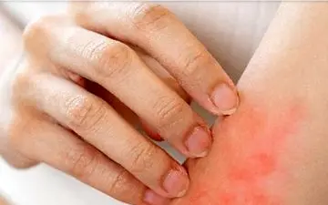 هنگام خارش ناشی از اگزما چکار باید کرد؟

