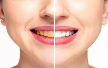 اشتباهی که باعث زردی دندان‌ها می‌شود
