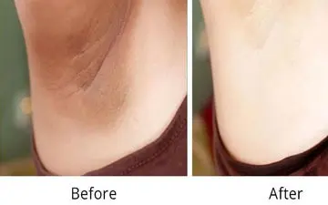 تیرگی اندام تناسلی چه موقع به وجود می آید؟