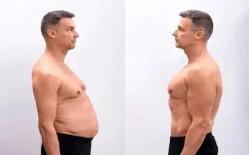 تفاوت ابدومینوپلاستی و لیپوساکشن چیست؟ چرا همه نمی‌توانند ابدومینوپلاستی انجام دهند؟