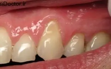  چه عواملی در از بین رفتن لثه ها مقصرند؟