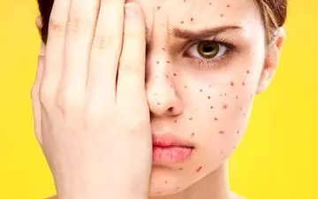 تفاوت بین آبله‌مرغان و زونا چیست؟ | آیا ممکن است کسی دو بار به آبله مرغان مبتلا شود؟