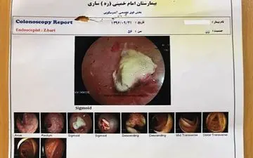 خارج کردن باند استریل بعد 10 سال از بدن بیمار در تهران+ تصاویر عجیب
