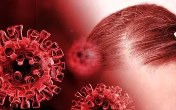 ریزش موی بیماران کرونایی مادام العمر است؟