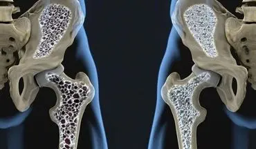 ۳ خطر بزرگ پوکی استخوان که کمتر کسی می‌داند