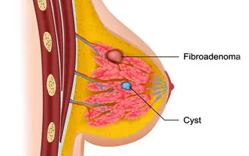 علائم کیست سینه چیست؟