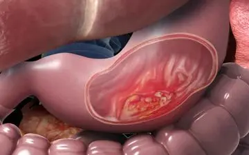 سرطان معده چیست؟ آن چه که باید بدانید 