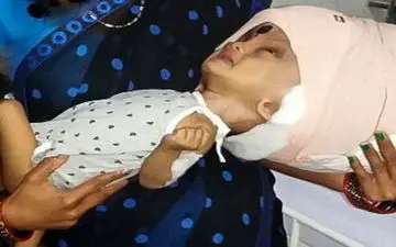 جراحیِ نوزاد هندی با بزرگترین سر جهان 