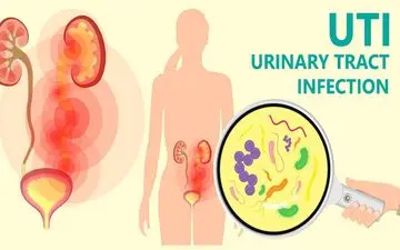 روشی برای درمان عفونت های ادراریِ مکرر