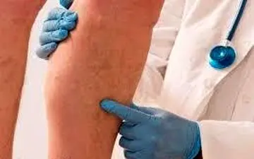  رژیم غذایی برای درمان واریس