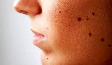  ۱۰ مورد از درمان‌های خانگی برای رفع لکه‌های سیاه روی پوست