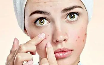 جوش صورت راچکار کنیم؟+ علل و راه‌های درمان 