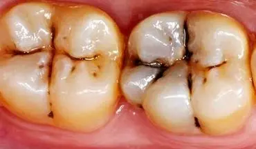 بایدهای پیشگیری از پوسیدگی دندان