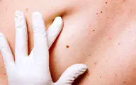 تست یک دقیقه‌ای نجات‌بخش؛ تشخیص سریع خطر سرطان کشنده پوست
