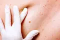 تست یک دقیقه‌ای نجات‌بخش؛ تشخیص سریع خطر سرطان کشنده پوست