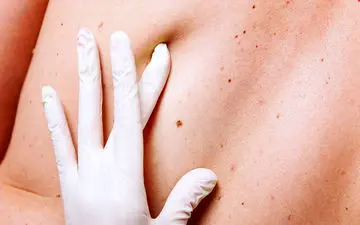 تست یک دقیقه‌ای نجات‌بخش؛ تشخیص سریع خطر سرطان کشنده پوست