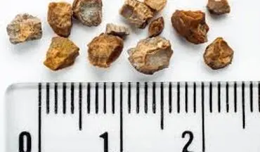 بهترین خوراکی‌ها برای جلوگیری از سنگ کلیه!