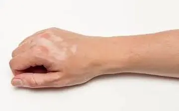 آشنایی با بیماری لک و پیس