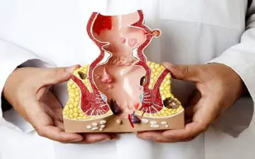 برای درمان بواسیر  چکار کنیم؟