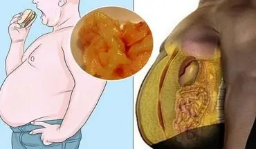 چربی شکمی  دلیل اصلی بی اختیاری ادرار!