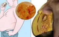 چربی شکمی  دلیل اصلی بی اختیاری ادرار!