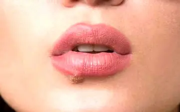 چند نکته برای کسانی که تبخال زده اند