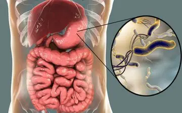 درمان طبیعی ورم معده و زخم معده + جزئیات