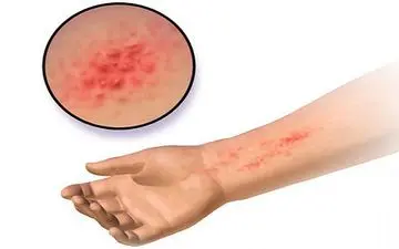 مراقب این بیماری مرگبار پس از حمام کردن باشید