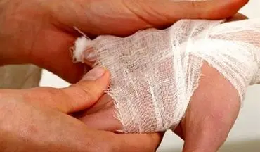 بستری سالانه 30هزار نفر بر اثر سوختگی در کشور/ باورهای غلط مانع درمان به موقع بیماران