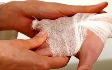 بستری سالانه 30هزار نفر بر اثر سوختگی در کشور/ باورهای غلط مانع درمان به موقع بیماران