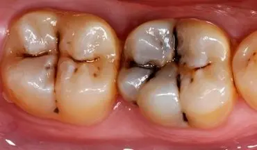 مهم‌ترین راه‌های پیشگیری از پوسیدگی دندان‌ها