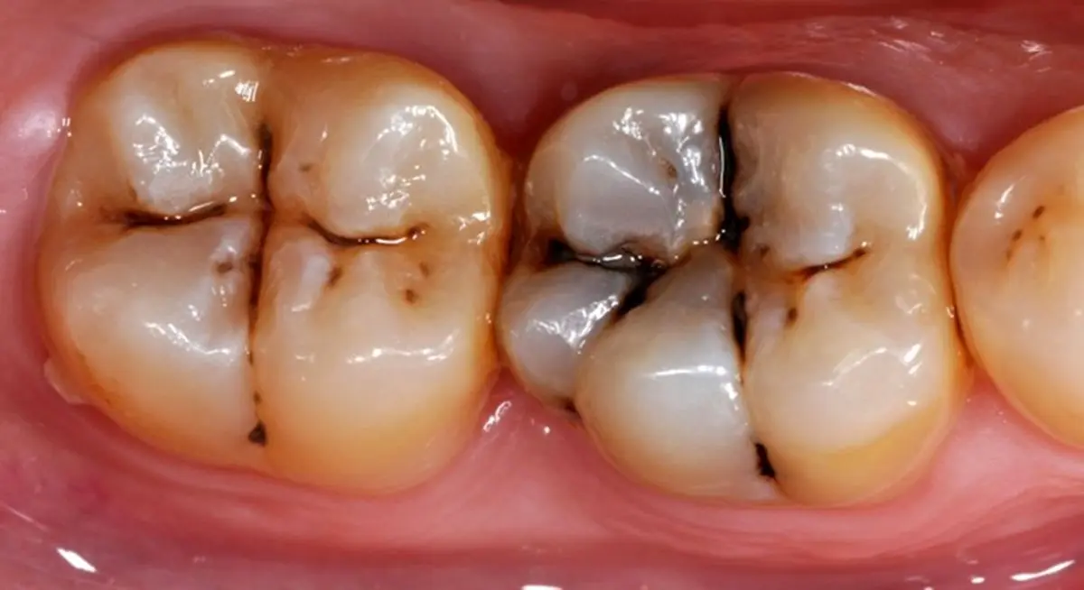مهم‌ترین راه‌های پیشگیری از پوسیدگی دندان‌ها