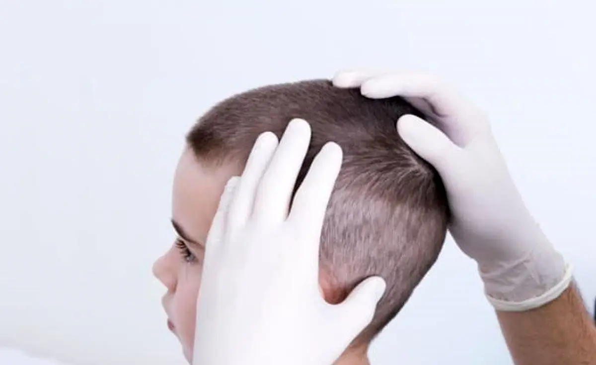 حشره ریزی که بلای موی سر می شود