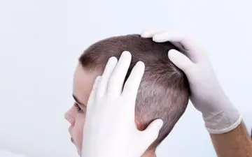 حشره ریزی که بلای موی سر می شود