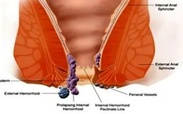 درمان بواسیر | با این روش ساده بواسیر را درمان کنید