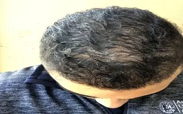 کمبود این ویتامین ها باعث  ریزش مو می شود!