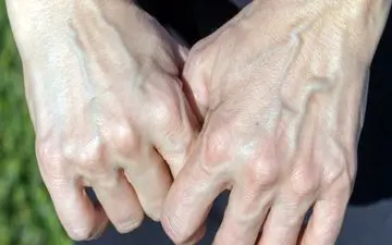 10 دلیل لرزش دست‌ها