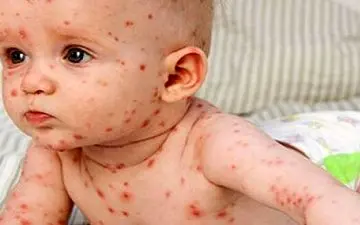 هشدار| مبتلایان به آبله مرغان در خانه بمانند