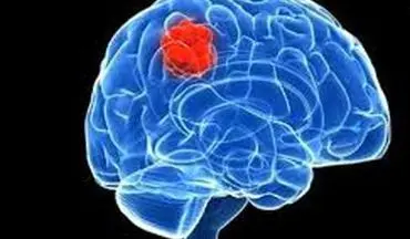  شایع‌ترین تومورهای مغزی تومورهای خوش خیم هستند 